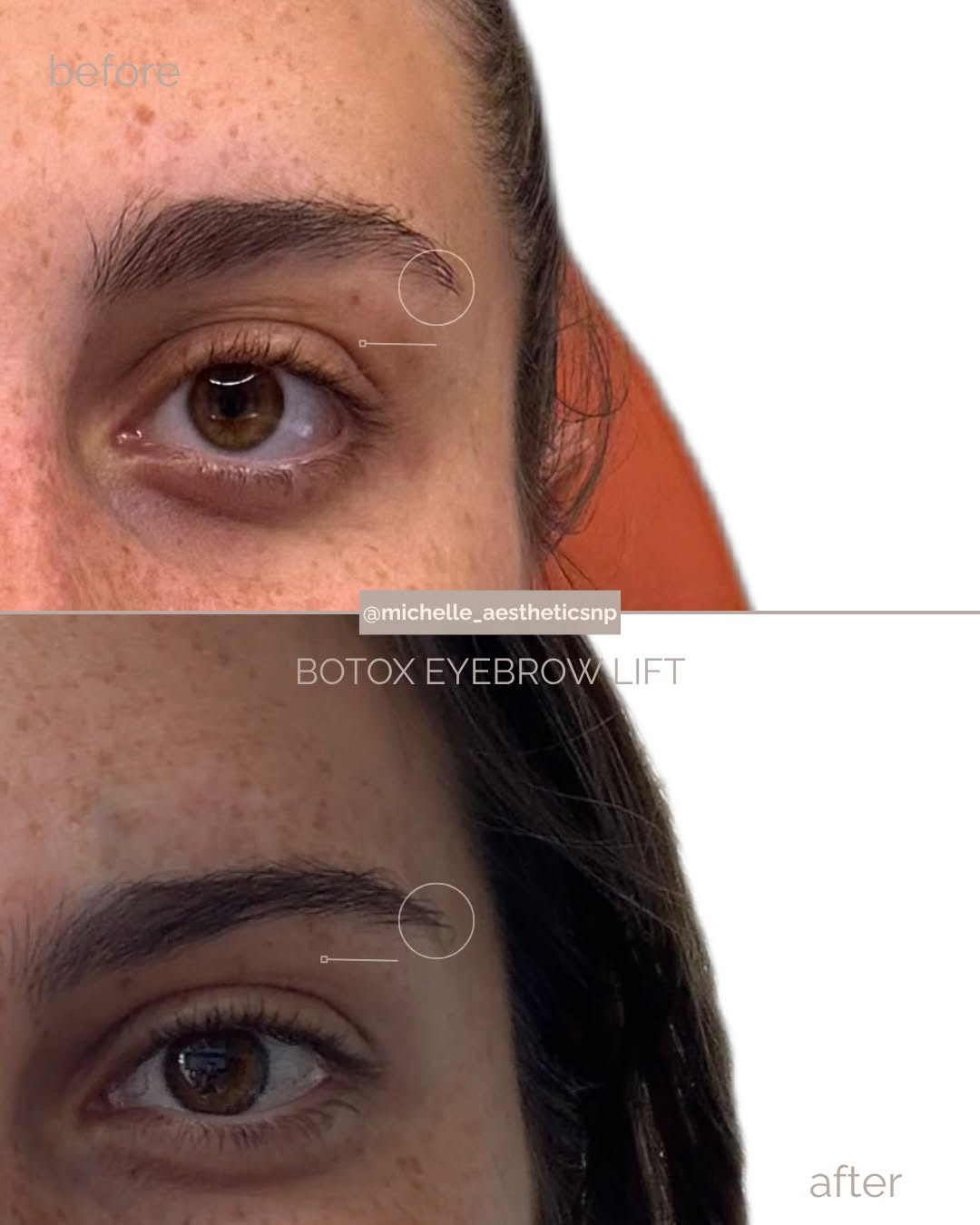 Instagram post by Dr. Alexander Blinski: My signature Botox eyebrow lift. Strategic placement, beautiful impact 🪄 The result helps create a more defined arch and a refreshed, lifte…