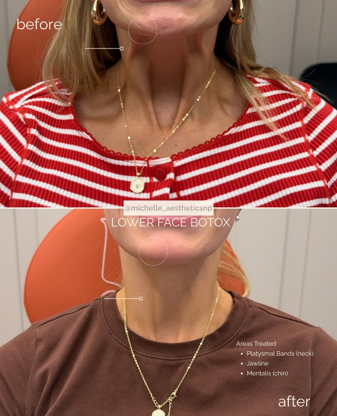 Instagram post by Dr. Alexander Blinski: Refining the jawline through strategic muscle treatment. 🪄 Platysmal band Botox can soften visible platysmal activity and reduce downward p…