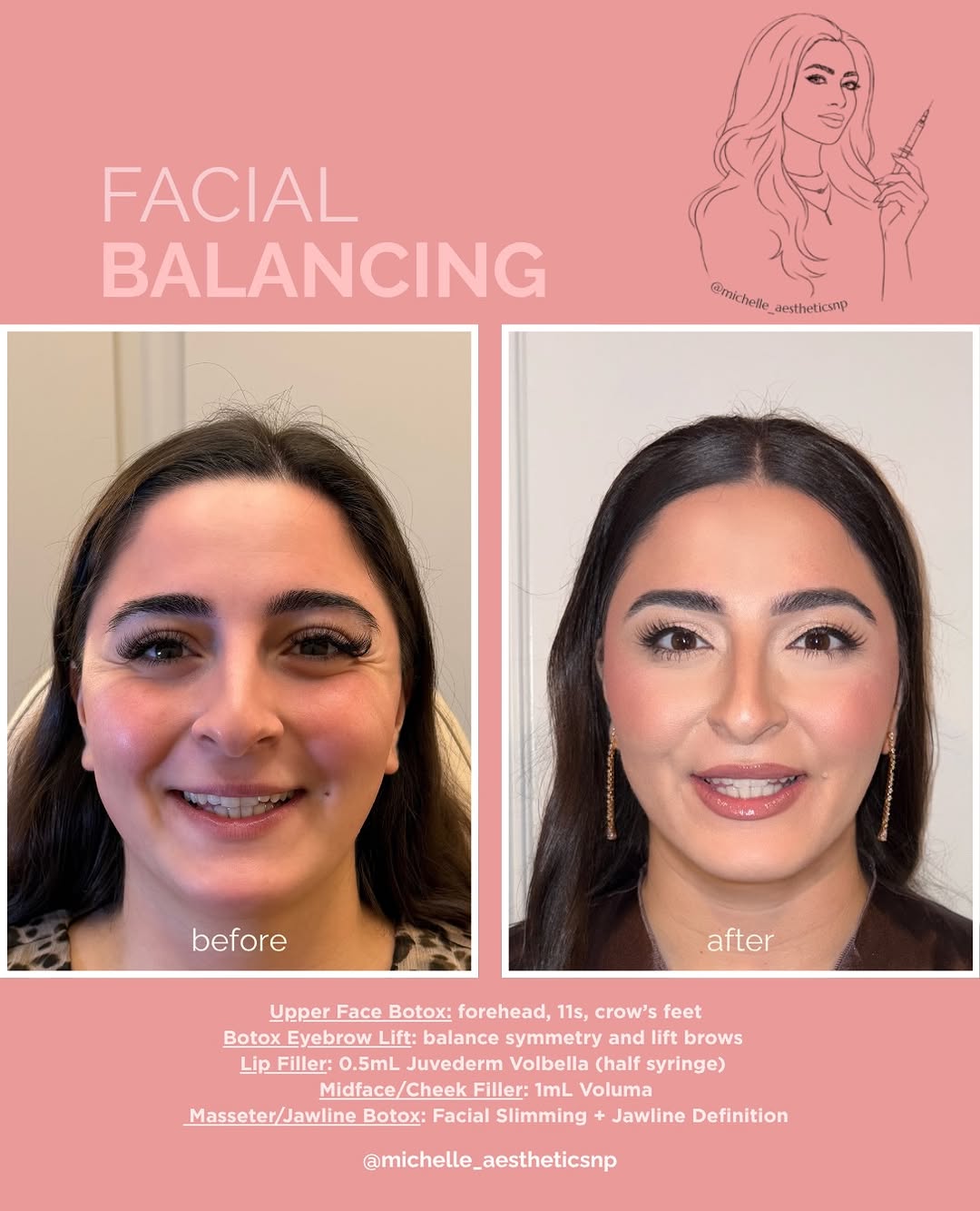 Instagram post by Dr. Alexander Blinski: She wanted more symmetry… and a softer, more refreshed version of herself. 🪄 Strategic tox + filler tailored to her anatomy helped create b…