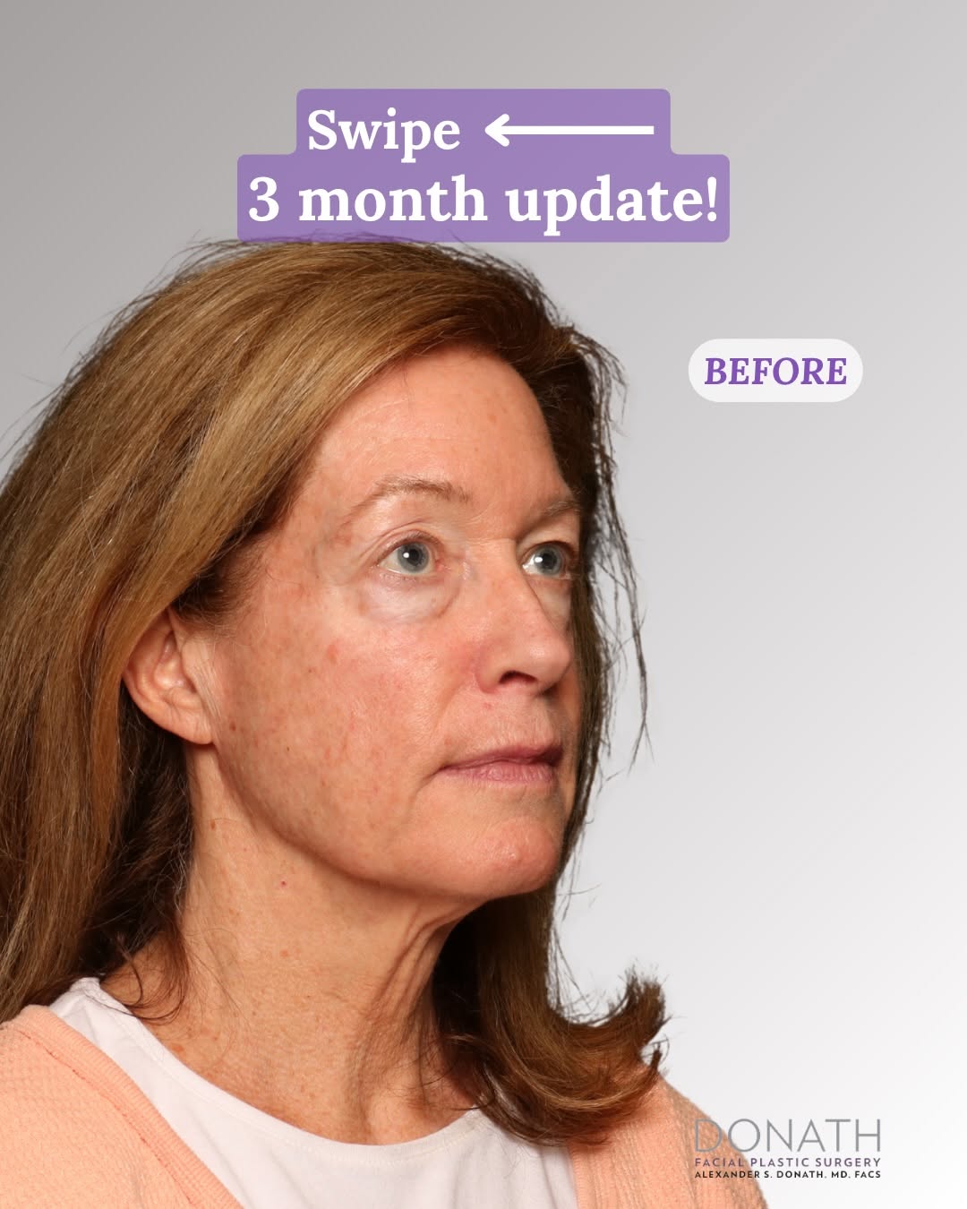Instagram post by Dr. Alexander Donath: 3 month postop! 🌟 We’re back with Colleen, 3 months post Luxelift℠ (midface, lower face, and neck lift), upper & lower blepharoplasty, fat …