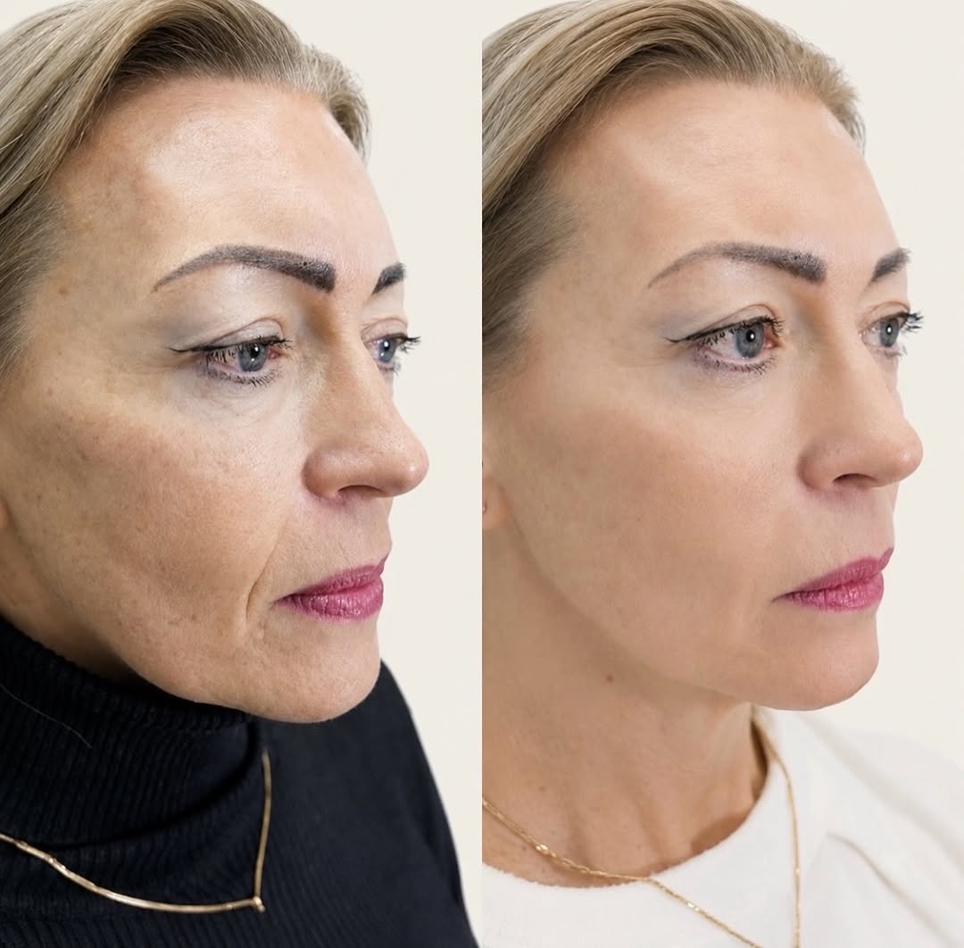 Instagram post by Dr. Alexander Golberg: 2 week post op, no surgery. Lifted, Refreshed, Rejuvenated. This is the Dr. G Lift. Lasts up to 18 months. For consultations, message me or …