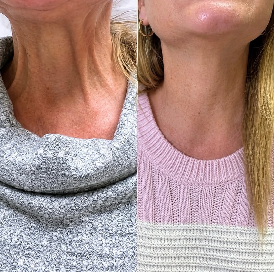 Instagram post by Dr. Alexander Golberg: No surgery. Little to No Downtime. Too good to be true? This is my Non-Surgical Neck Lift. The neck deserves the same amount of attention li…