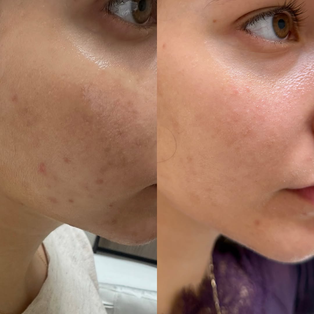 Instagram post by Dr. Alexander Golberg: Real Patient. Real Results. These two photos are 3 months apart. Acne problems, Scars, Discoloration, Etc. The solution to all these problem…