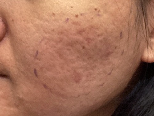 Instagram post by Dr. Alexander L. Berlin: Laser? Microneedling? Chemical peels? Sometimes none of those are the best first treatment. The scars in these photos are called rolling sca…