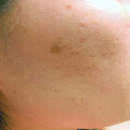 Instagram post by Dr. Alexander L. Berlin: What are those white dots? They’re called “frosting,” and they appear immediately after TCA-CROSS treatment for acne scars. TCA-CROSS is dif…