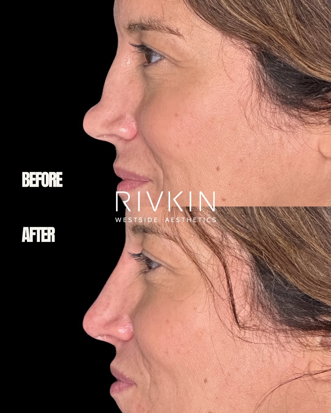 Instagram post by Dr. Alexander Rivkin: Would you have guessed this wasn’t surgery? 👃💉 This right here is why I do what I do. Watching a patient see herself with a new level of c…