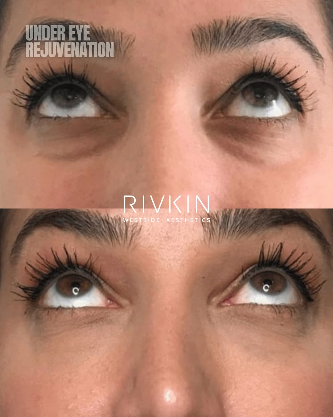 Instagram post by Dr. Alexander Rivkin: THE UNDER-EYE ERA HAS CHANGED. 💉 For years, treating under-eye hollows meant one thing: filler. Now, under-eye rejuvenation has become far …