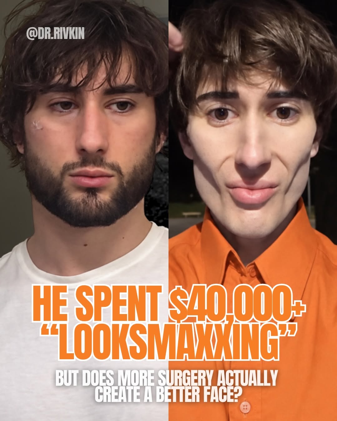 Instagram post by Dr. Alexander Rivkin: $40,000+ on “looksmaxxing” and the internet is VERY divided on the result. According to the viral post, he says he had two buccal fat remova…