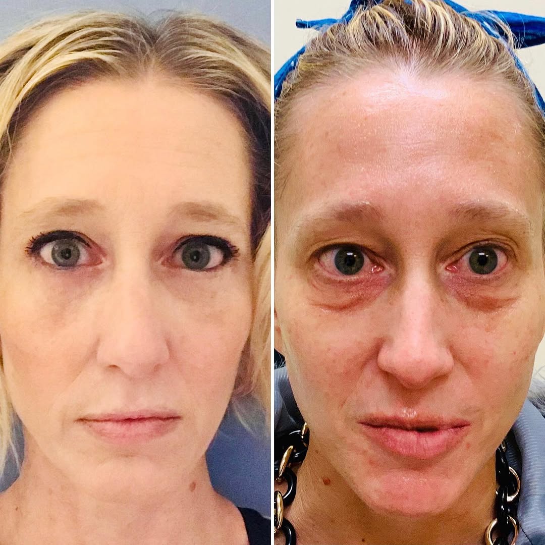 Instagram post by Dr. Alexandra Braunstein: “And YES I’m ready to go viral 😆 . I looked in the mirror today and saw “myself” again. So grateful.” Best compliment a surgeon can receive…