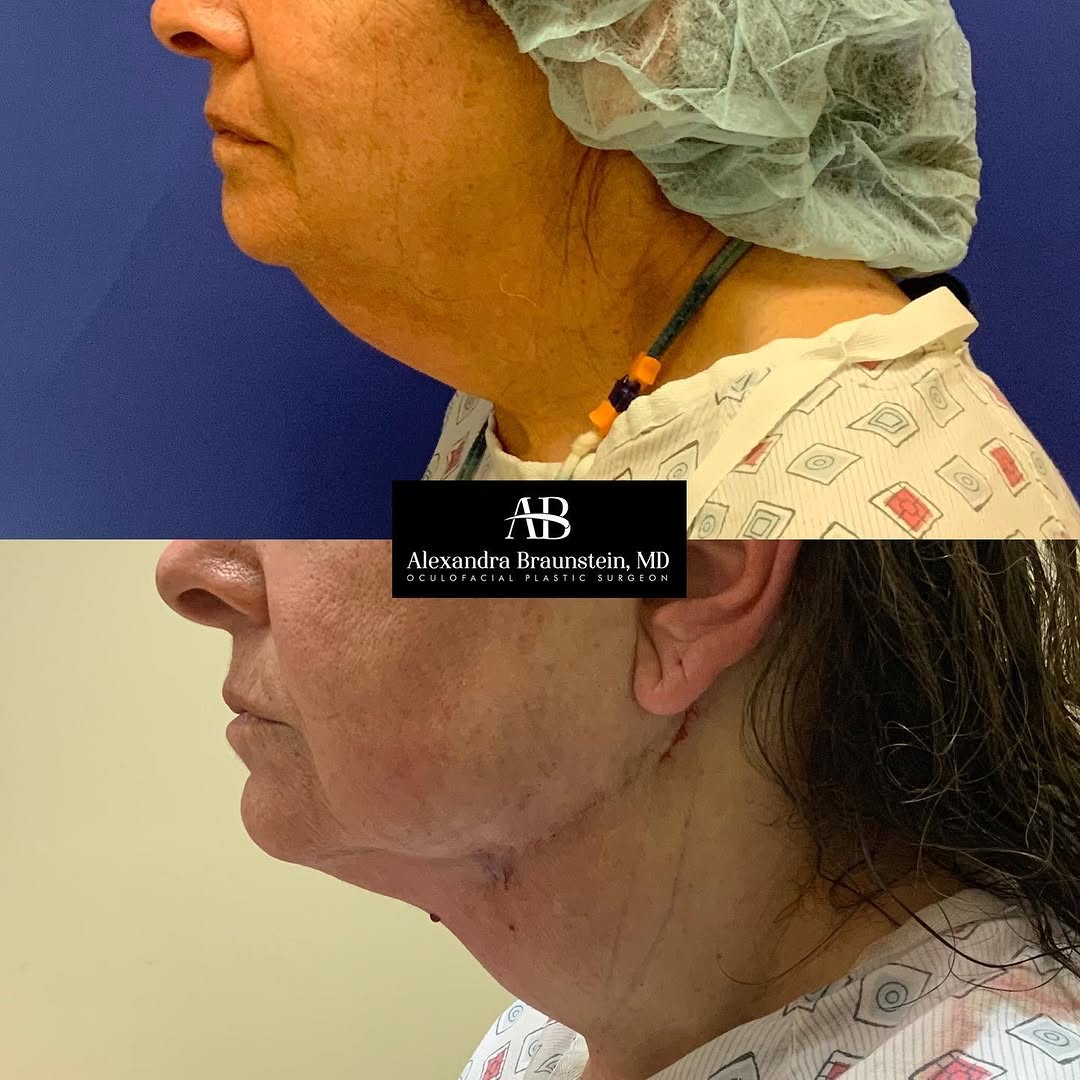 Instagram post by Dr. Alexandra Braunstein: So excited to add the “zoom neck lift” to my practice. This before and after is 2 hours apart! The patient had Facetite, lipo sculpting and …