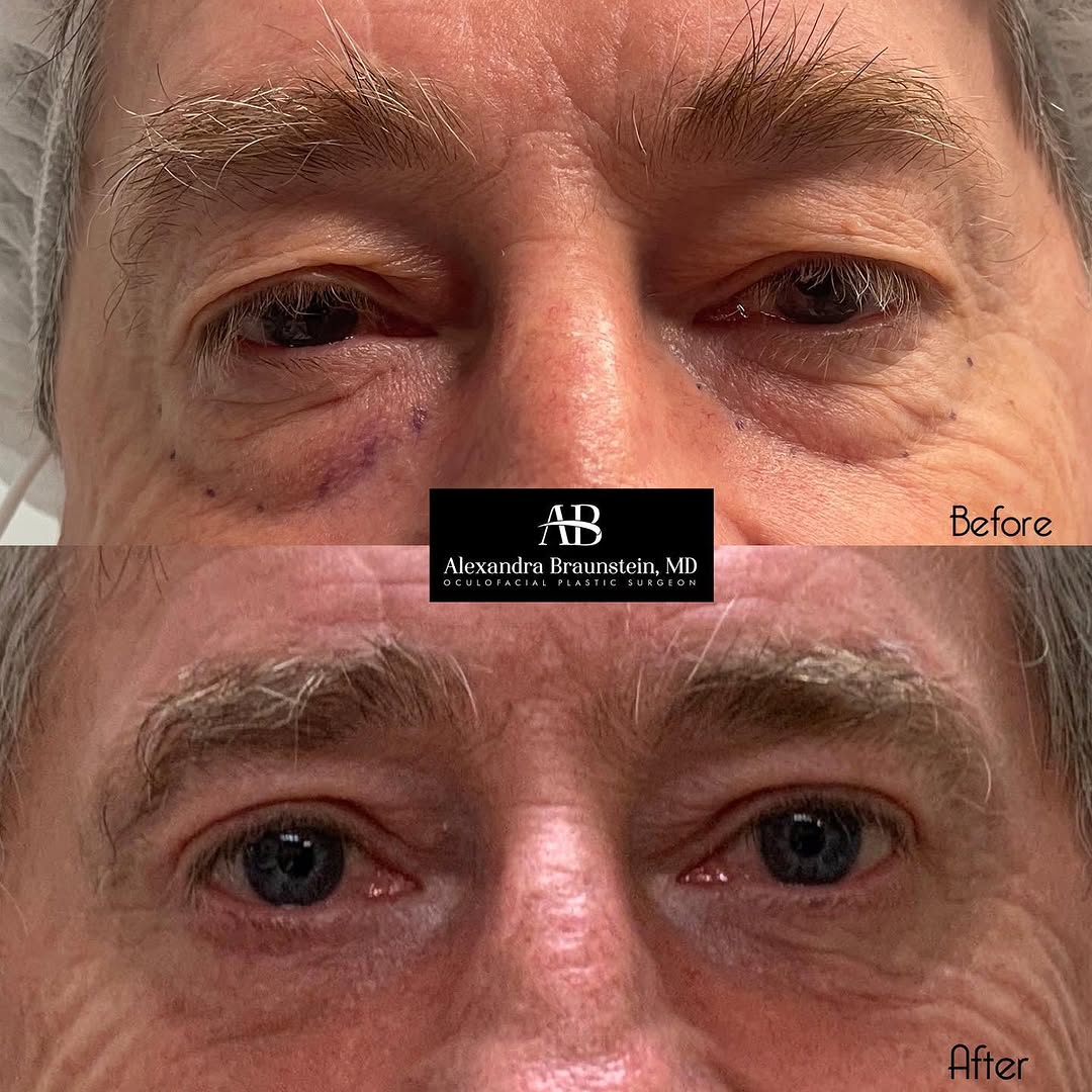 Instagram post by Dr. Alexandra Braunstein: 3 months after and upper and lower lid blepharoplasty and looking great. His wife summed it up when she simply exclaimed, “Wow!”. The patien…