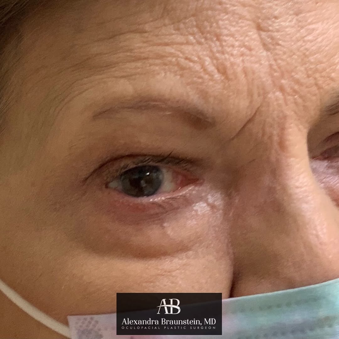 Instagram post by Dr. Alexandra Braunstein: 14 months ago, we were on lockdown and all elective procedures were on hold in NJ for COVID-19. This patient had an aggressive skin tumor th…