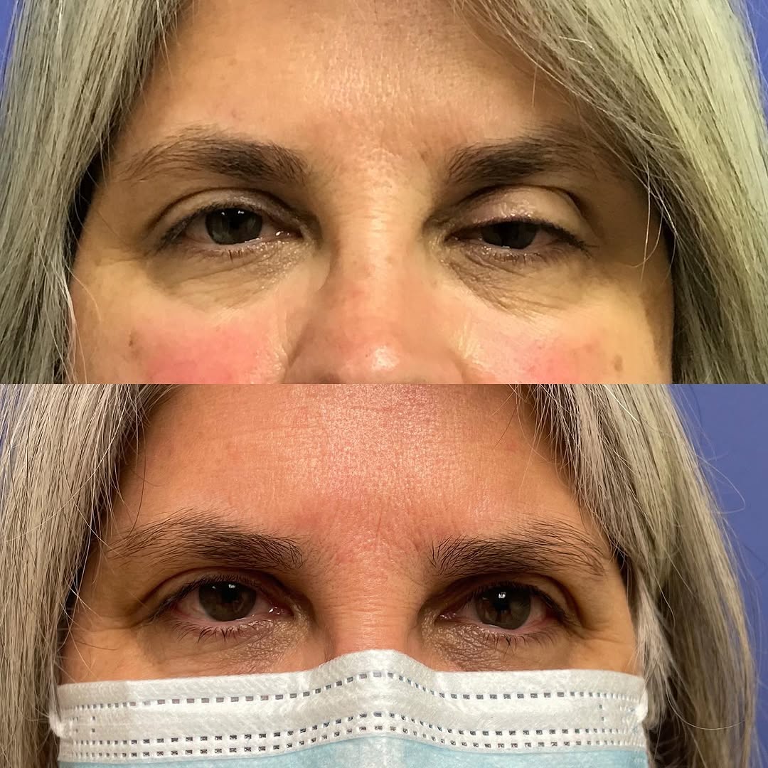 Instagram post by Dr. Alexandra Braunstein: An elegant surgery can restore symmetry and function in under an hour. #ptosis #eyelidlift #eyelidexpert #oculoplastics #oculoplasticsurgeon…