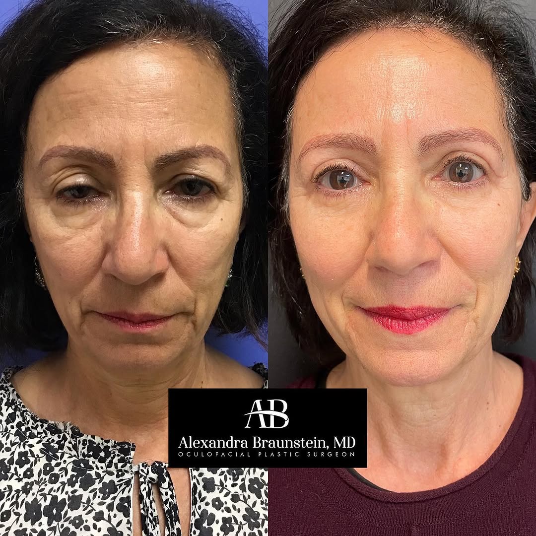 Instagram post by Dr. Alexandra Braunstein: This lovely patient is thrilled with her results 3 months after undergoing 4 lid blepharoplasty with ptosis repair. What do you think of her…