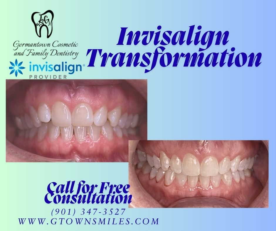 Instagram post by Dr. Alexandra Garrett, DDS: Straighter better smile with Invisalign #memphisbraces #memphisinvisalign #germantowninvisalign #germantowndentist #memphisdentist #invisali…