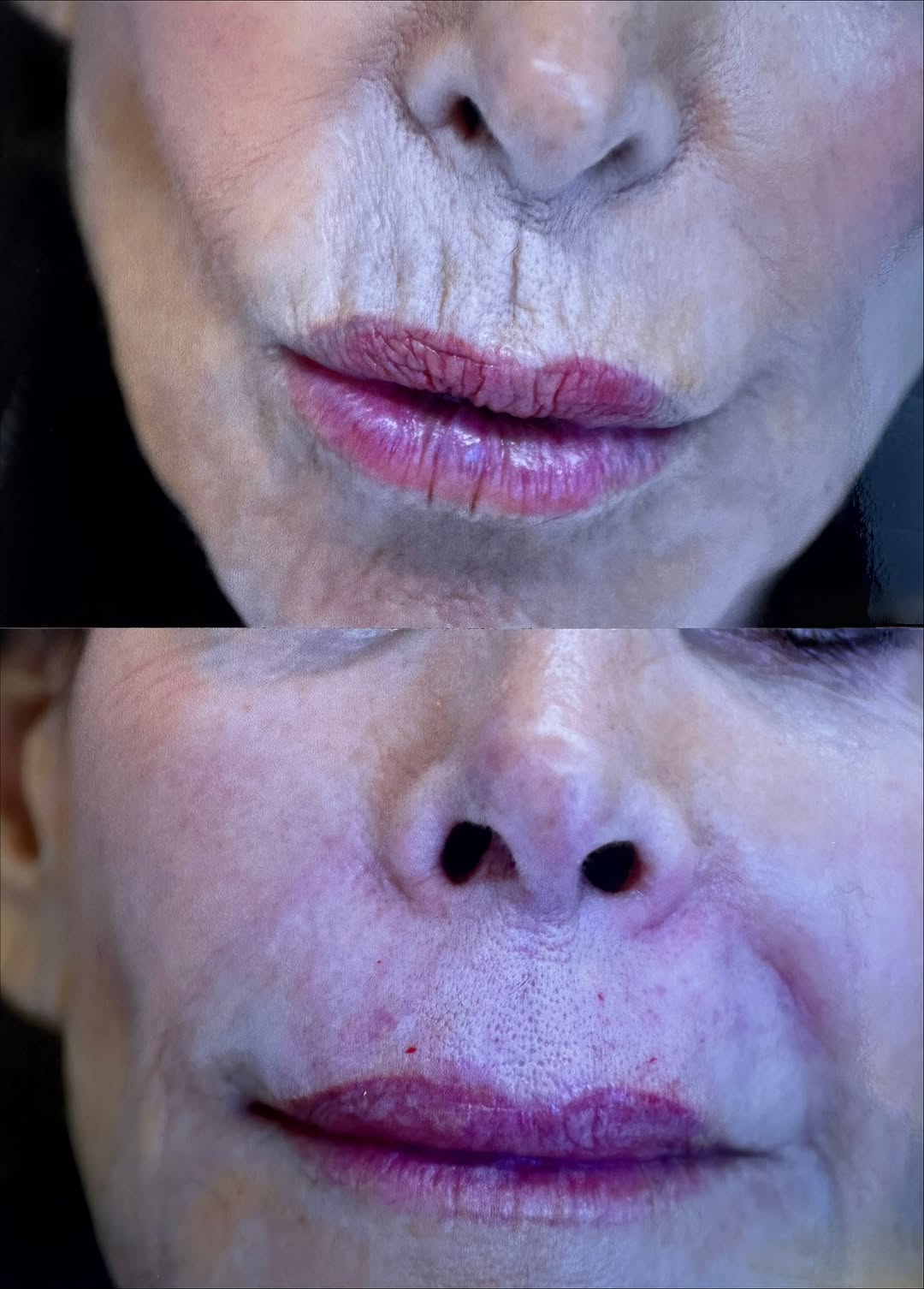 Instagram post by Dr. Alfred Cohen: 💋 A Subtle Refresh — Upper Lip Rejuvenation with Restylane 💋 As we age, it's natural to notice changes in the lips and surrounding skin — …
