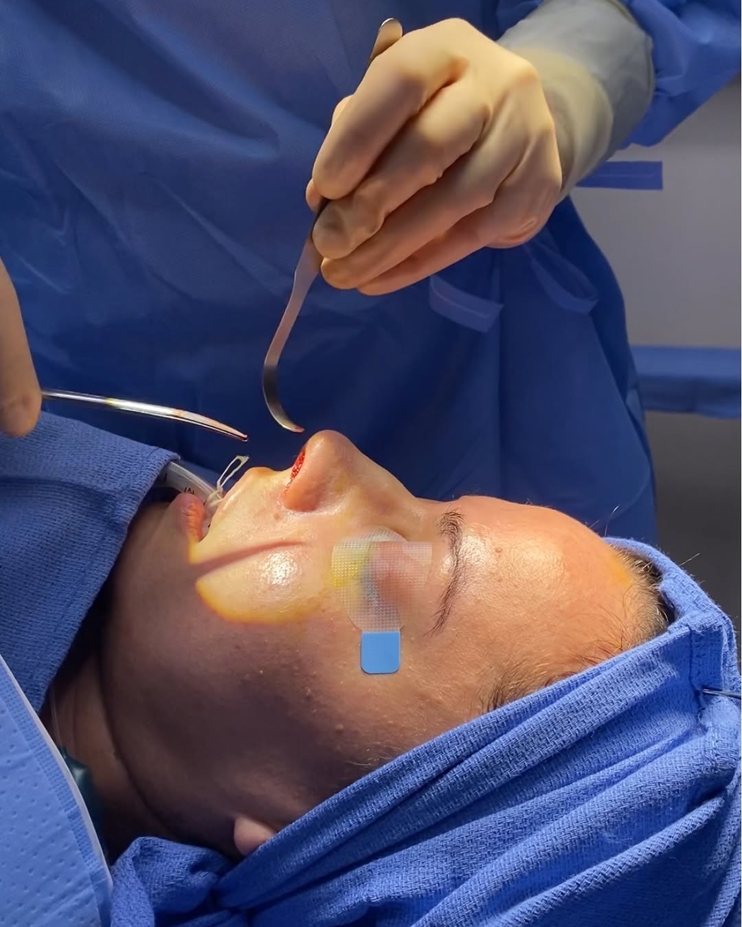 Instagram post by Dr. Alfred Cohen: No Scars? No Problem! Thinking about rhinoplasty but want minimal downtime & no visible scars? Let’s talk about closed rhinoplasty! 👃💫 …