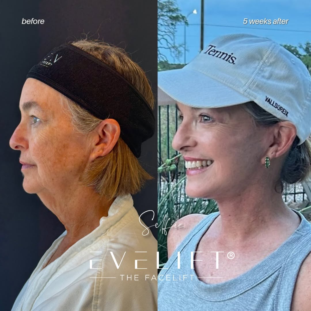 Instagram post by Dr. Ali Charafeddine: “My results are already blowing me away!” 💫 Meet Ann, 60-years-young, who flew in from Austin, TX for her EVELift®, upper eyelid blepharopl…