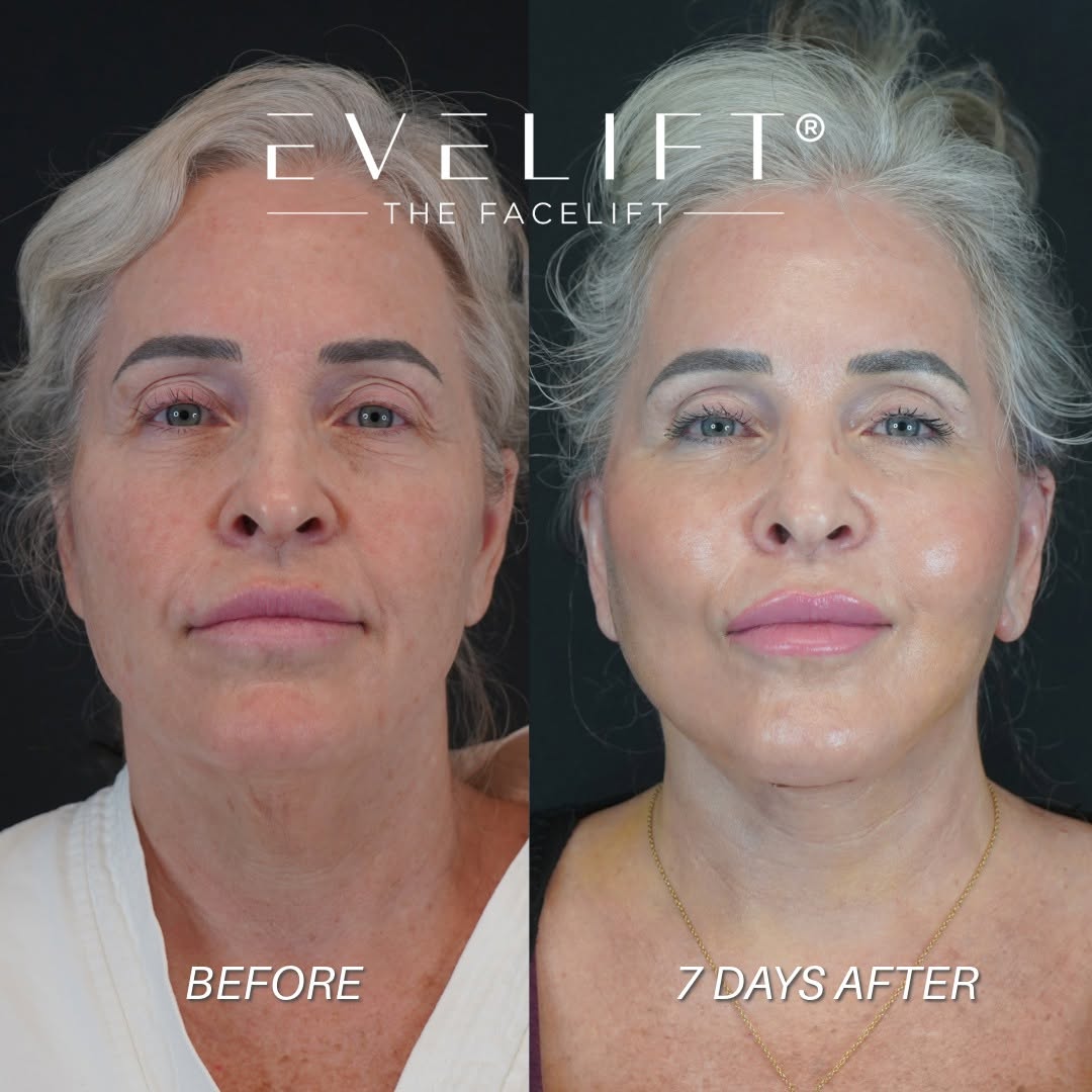 Instagram post by Dr. Ali Charafeddine: 7 days post-op… and Wendy’s early results are already taking shape. 👀✨ Wendy, 57, traveled from Texas for her EVELift® facelift and necklif…
