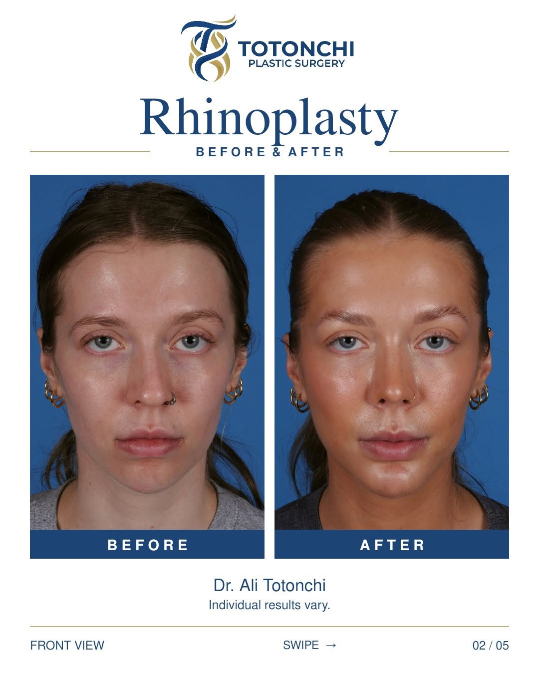 Instagram post by Dr. Ali Totonchi: A closer look at rhinoplasty results. ✨ This before-and-after highlights one patient’s rhinoplasty with Dr. Ali Totonchi. Every face is uniq…