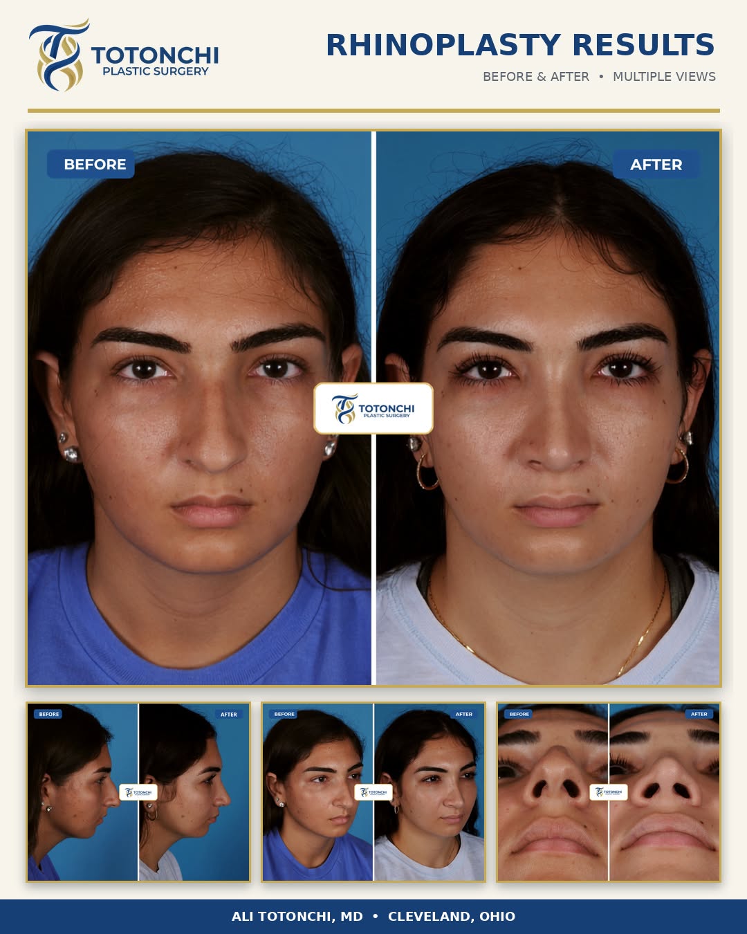 Instagram post by Dr. Ali Totonchi: Natural refinement. Beautiful balance. Results designed for the individual. ✨ This rhinoplasty transformation by award-winning plastic surge…