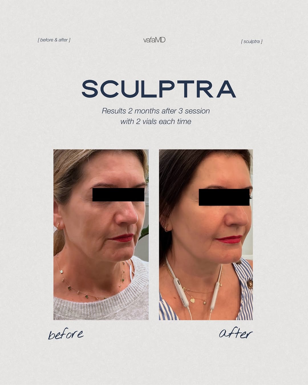 Instagram post by Dr. Ali Vafa: Signature Sculptra Treatment 💉💉💉 ⠀ WHAT IT DOES: This biostimulator treatment, enhances and restores facial volume, facial structure, and…