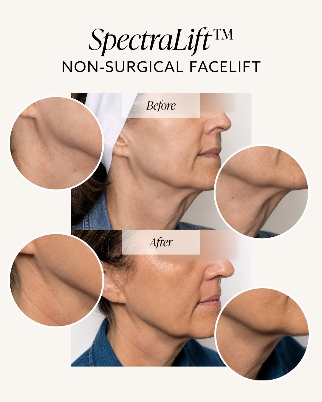 Instagram post by Dr. Alice Pien: SpectraLift™ — AMA’s Non-Surgical Facelift SpectraLift™ is a comprehensive, non-invasive treatment protocol that combines 25+ advanced laser…