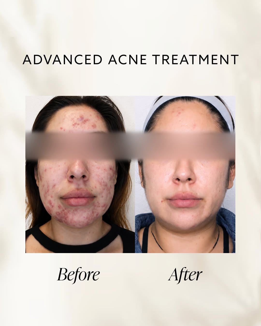 Instagram post by Dr. Alice Pien: Acne is complex. Your treatment plan should be personalized to you. ✨ At AMA Regenerative Medicine & Skincare, our Advanced Acne Treatments …