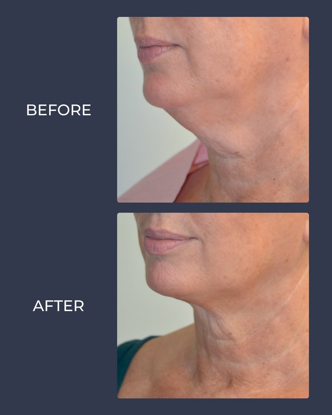 Instagram post by Dr. Allen M. Doezie: A more defined jawline starts here! Submental liposuction removes stubborn fat beneath the chin to enhance your jawline and create a smoothe…