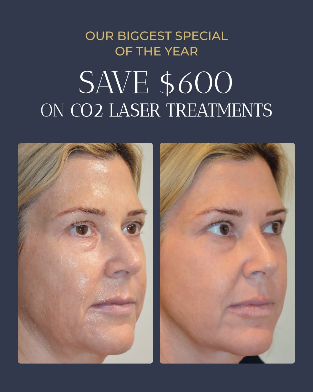 Instagram post by Dr. Allen M. Doezie: Your skin deserves a refresh - and there’s never been a better time! For the month of September, save $600 on CO2 Laser treatments during ou…