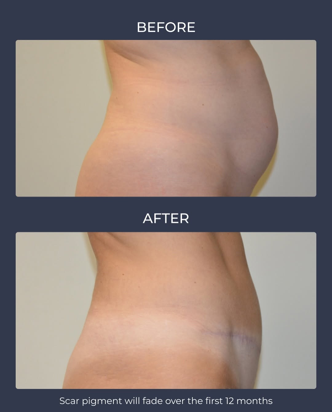 Instagram post by Dr. Allen M. Doezie: Have a strong core but still dealing with stubborn fat and excess skin? An Abdominoplasty (Tummy Tuck) can help remove excess skin and impro…