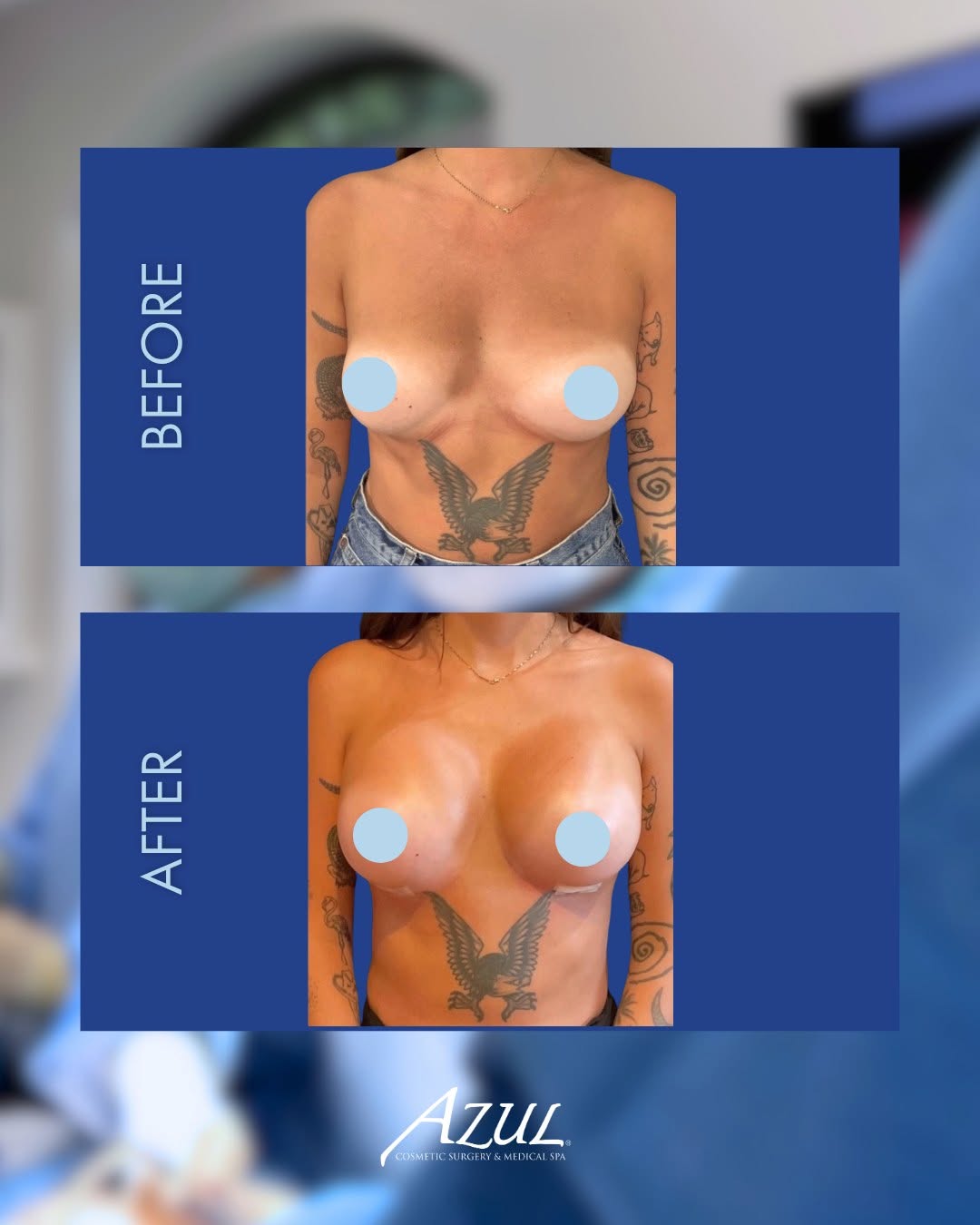 Instagram post by Dr. Allison Yee: This patient desired a noticeably fuller, rounder bust with a more pronounced profile. Through thoughtful, personalized conversations, @verr…