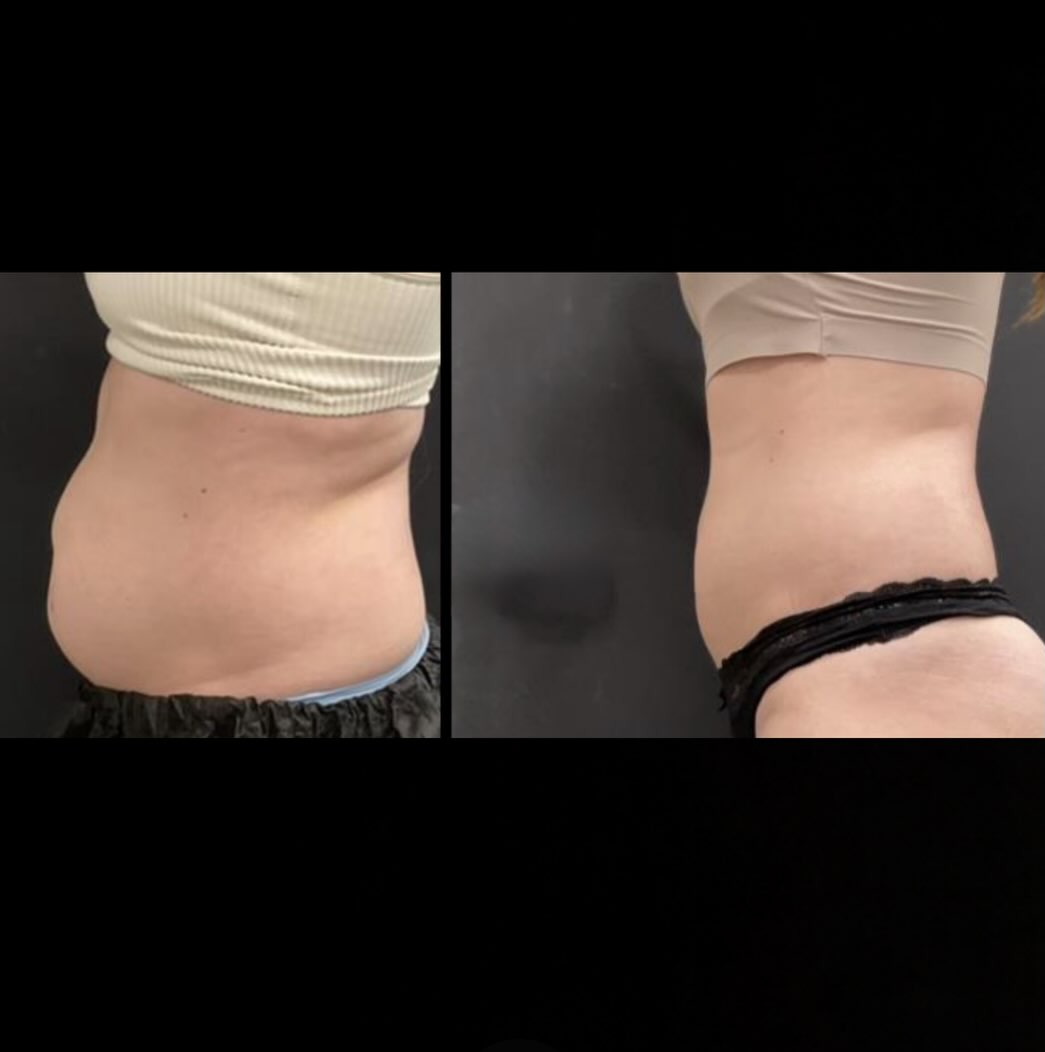 Instagram post by Dr. Allison Yee: Another happy CoolSculpting patient!❄️ This is why I love body contouring! 💙 My 33yr old patient struggled with unwanted belly fat for year…