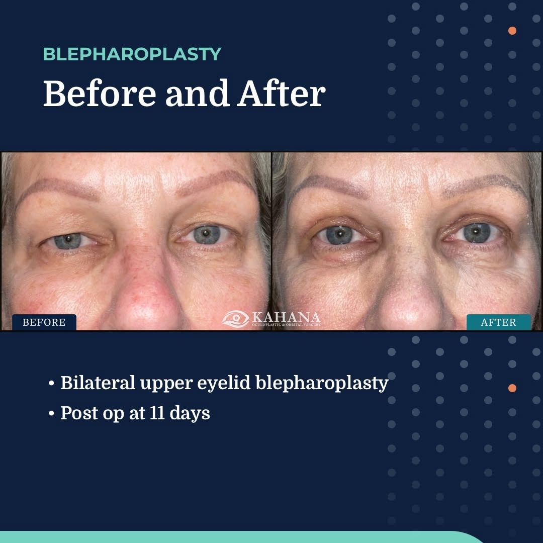 Instagram post by Dr. Alon Kahana: Dr. Kahana and the team at Kahana Oculoplastic and Orbital Surgery specialize in cosmetic surgeries and procedures for facial rejuvenation w…