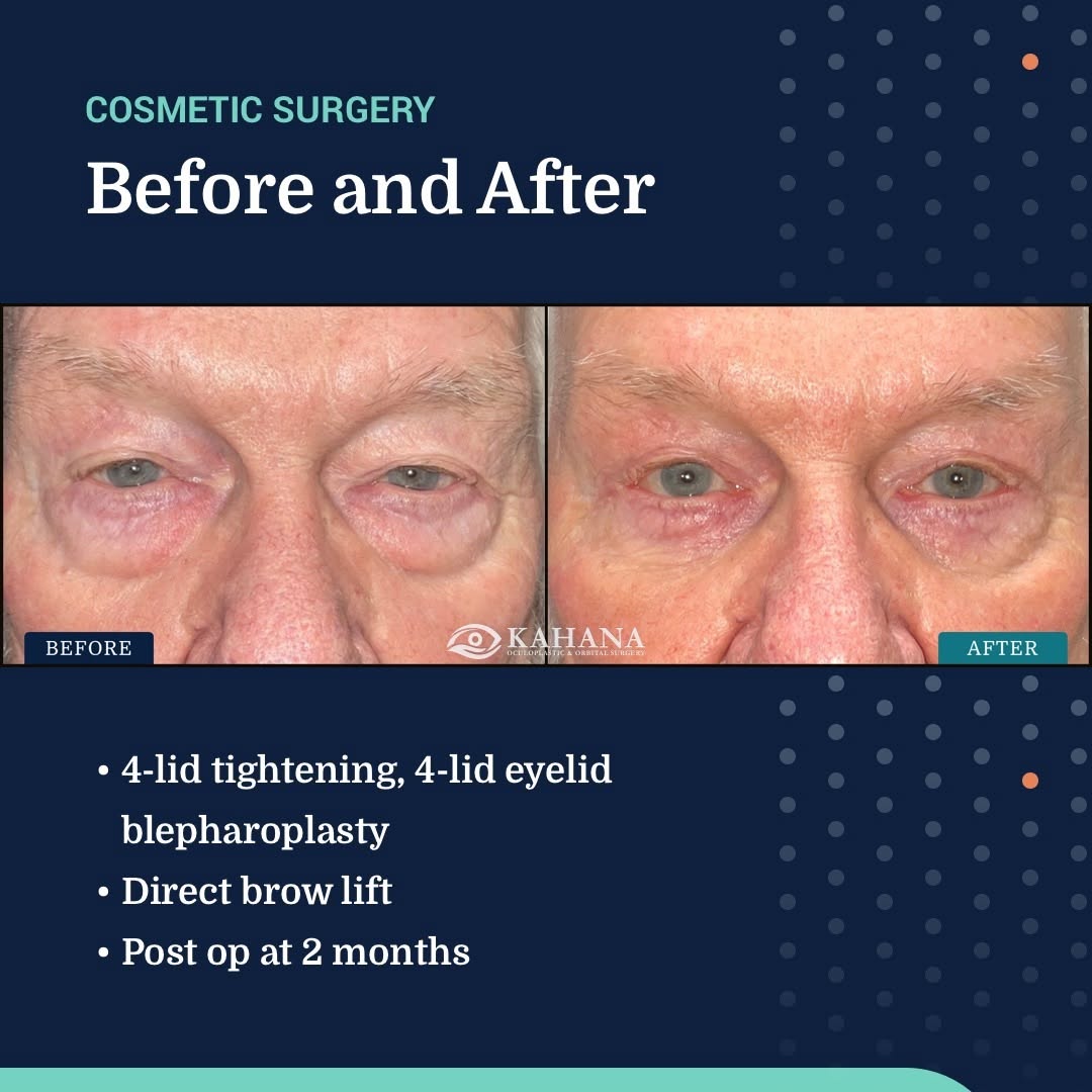 Instagram post by Dr. Alon Kahana: Dr. Kahana and the team at Kahana Oculoplastic and Orbital Surgery specialize in cosmetic surgeries and procedures for facial rejuvenation w…
