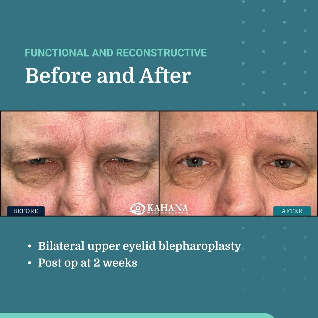Instagram post by Dr. Alon Kahana: Dr. Kahana and the team at Kahana Oculoplastic and Orbital Surgery specialize in cosmetic surgeries and procedures for facial rejuvenation w…