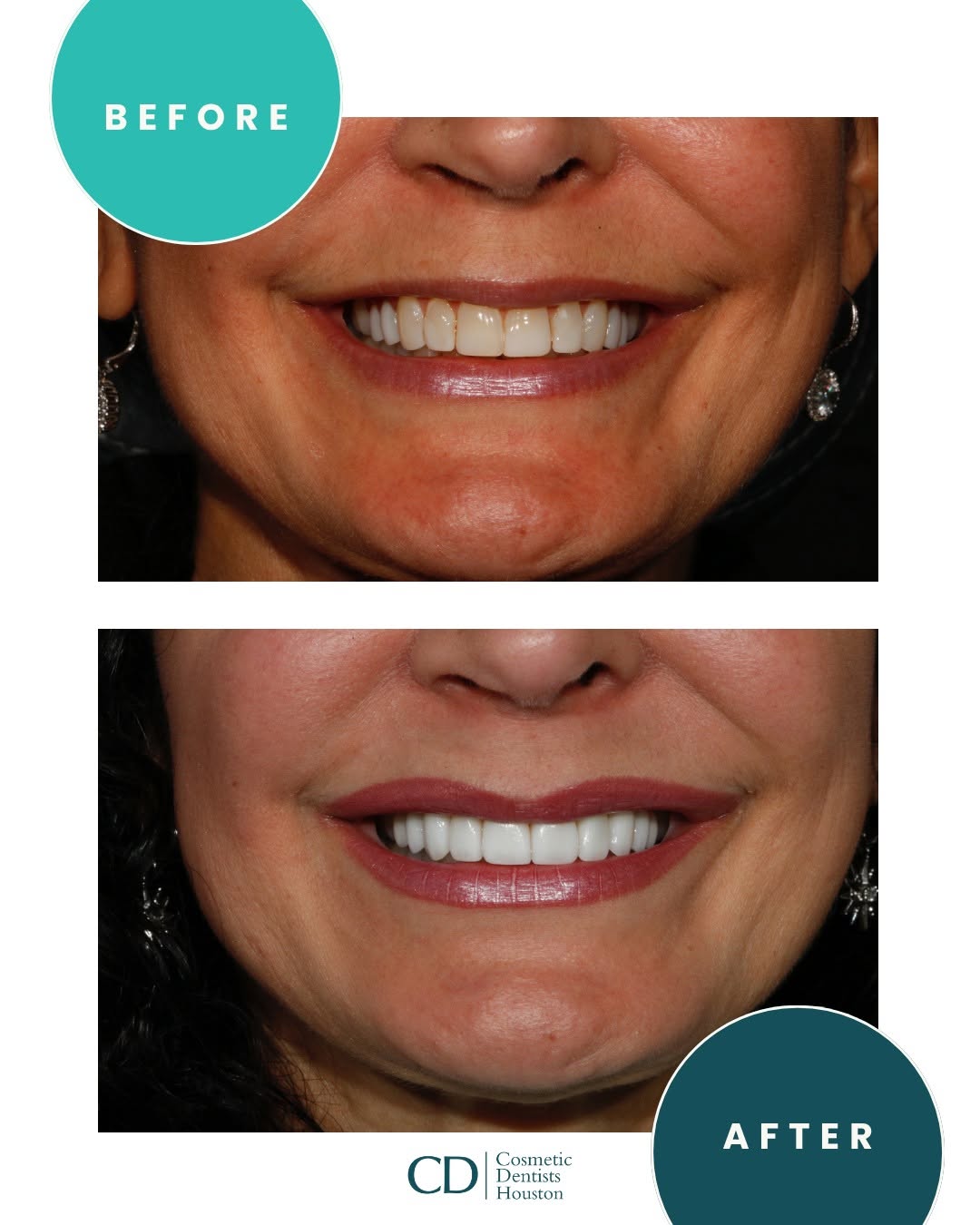 Instagram post by Dr. Amanda Canto, DDS: A transformation that still feels like you, just brighter, more balanced, and designed with intention. Your smile can change the way you sho…
