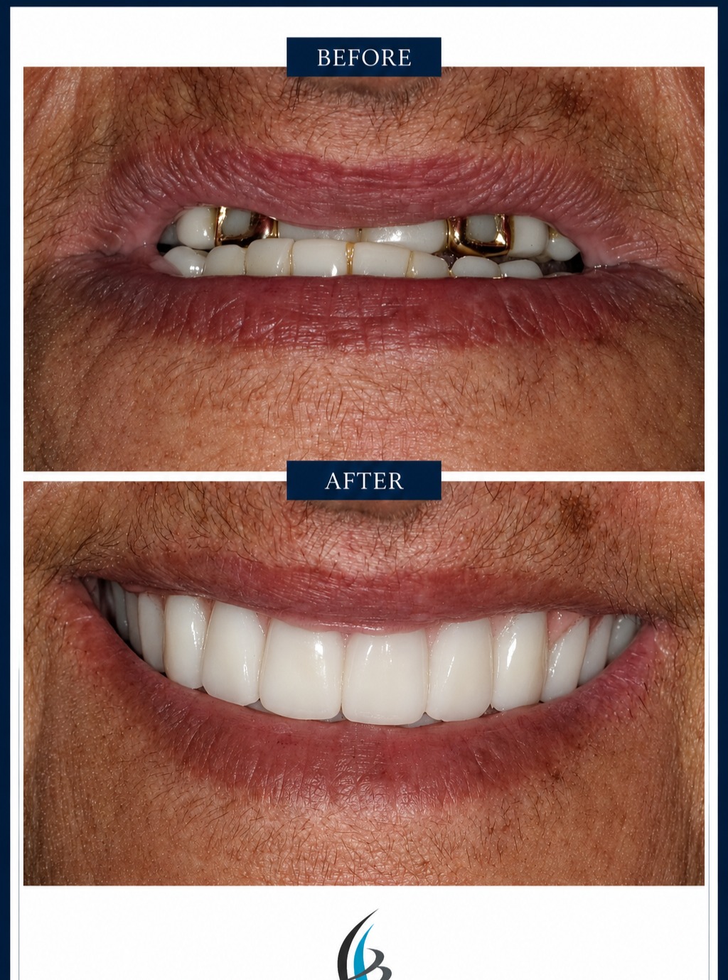 Instagram post by Dr. Amanda McPherson: This patient was wearing dentures that did not align her jaws properly. It gave her the appearance of having an "underbite." Not only did sh…