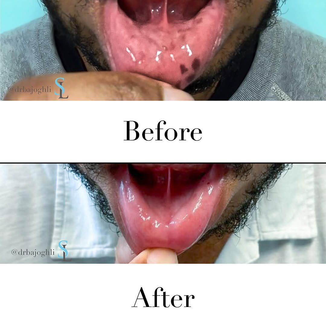 Instagram post by Dr. Amir Bajoghli: Did you know? Lentigines (aka sun spots) can vanish with PicoWay laser! Our patient of color had pigment on his lip fade away with just one …
