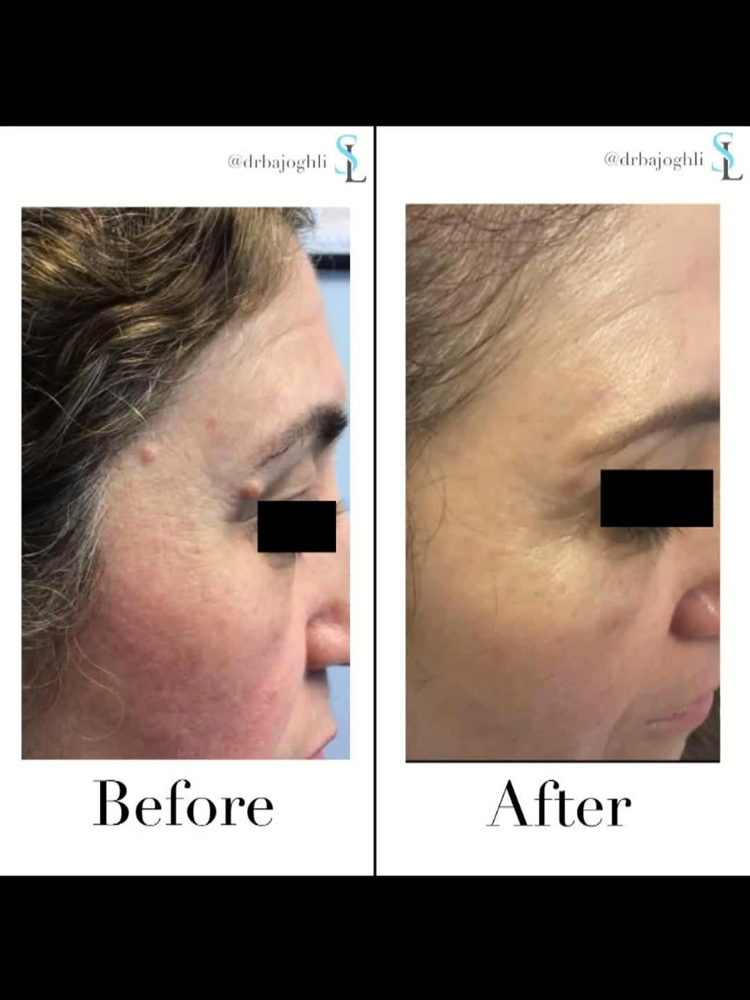 Instagram post by Dr. Amir Bajoghli: CO2 laser treatment (QuadraLase) is a precise and effective method for removing several skin lesions including intradermal nevi, benign mole…