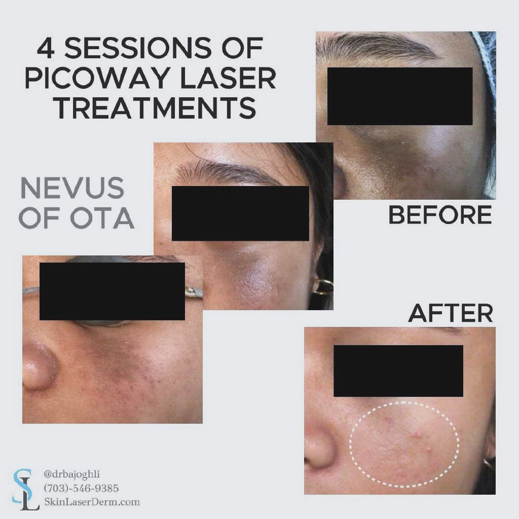 Instagram post by Dr. Amir Bajoghli: 📸Want to get rid of unwanted birthmarks? This patient has had a nevus of Ota, a brown birthmark beneath her eyelid for most of her life. Wa…