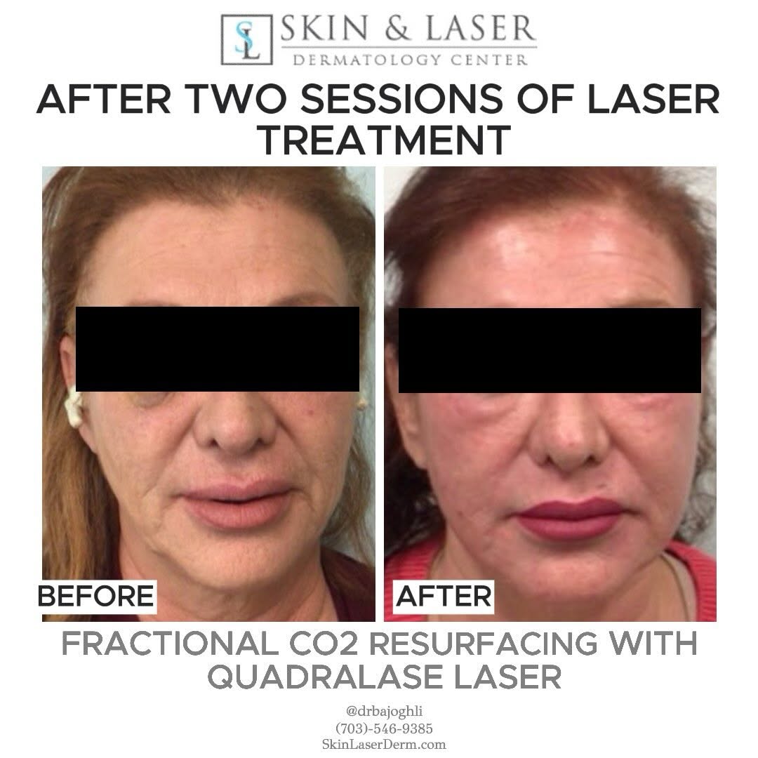 Instagram post by Dr. Amir Bajoghli: Want long-lasting improvements to skin quality? Interested in restoring your natural beauty? This patient came to our office wanting to impr…