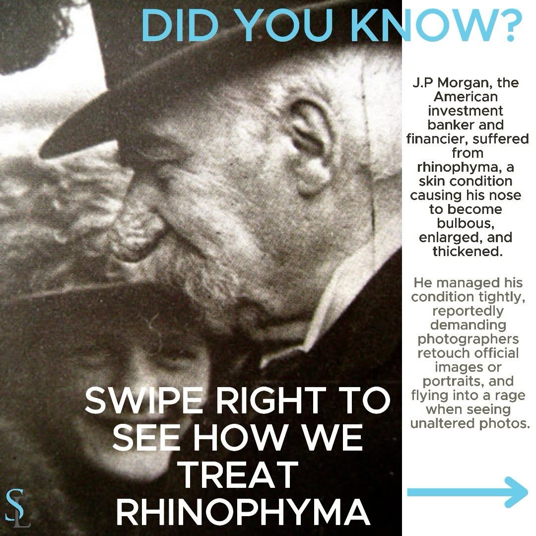 Instagram post by Dr. Amir Bajoghli: Fun Fact Friday: Did You Know? Rhinophyma is a disfiguring disorder of the nose, often related to untreated rosacea. It is caused by an over…