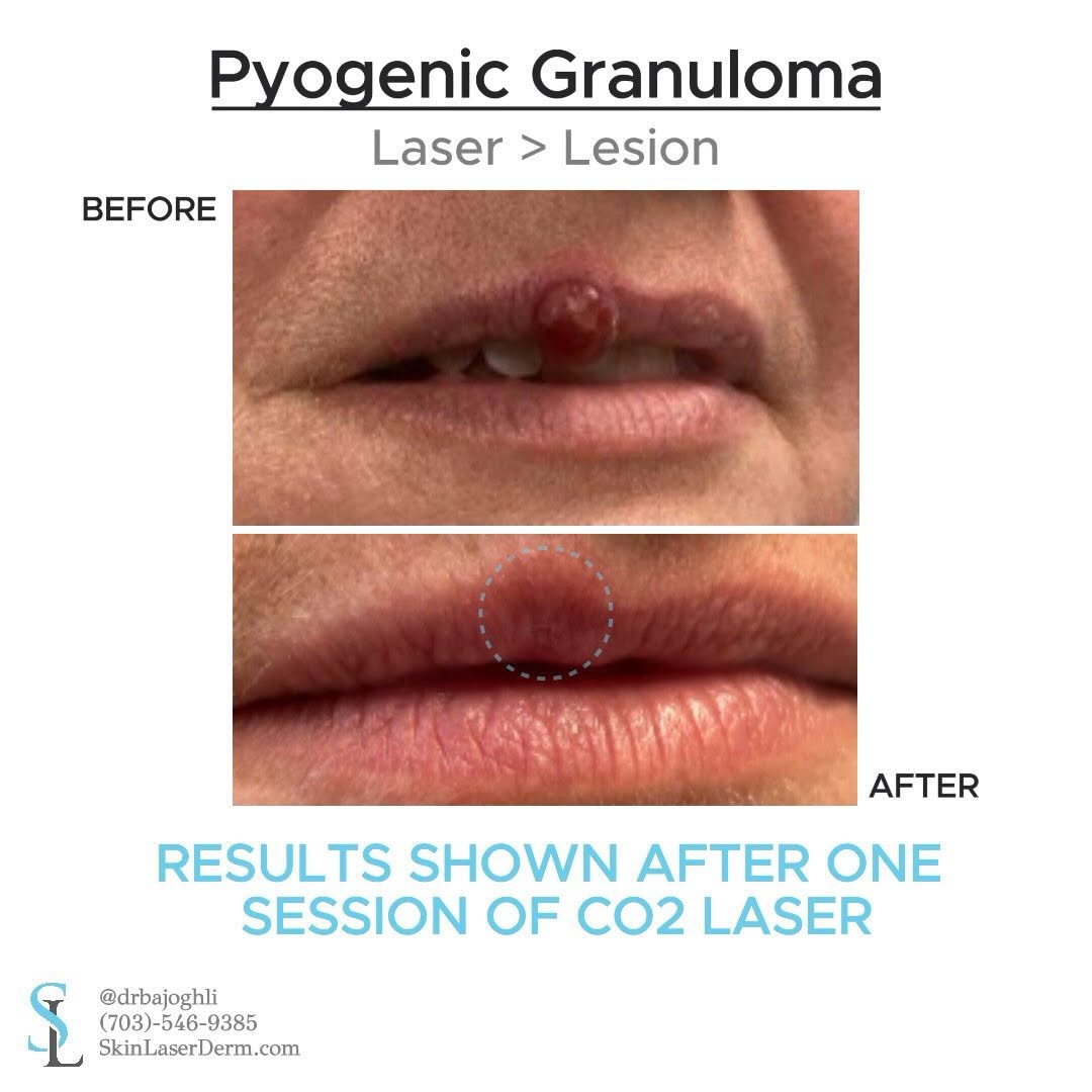 Instagram post by Dr. Amir Bajoghli: “Bye-ogenic Granuloma” 👋 This patient was referred for treatment of a biopsy-proven pyogenic granuloma, a benign vascular lesion that can a…