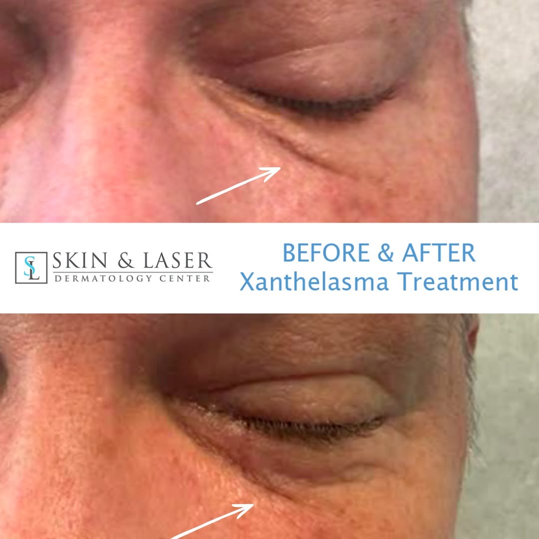 Instagram post by Dr. Amir Bajoghli: Example of Xanthelasma, yellowish bumps of fatty deposits, being treated with one CO2 laser session. Natural results with minimal downtime a…