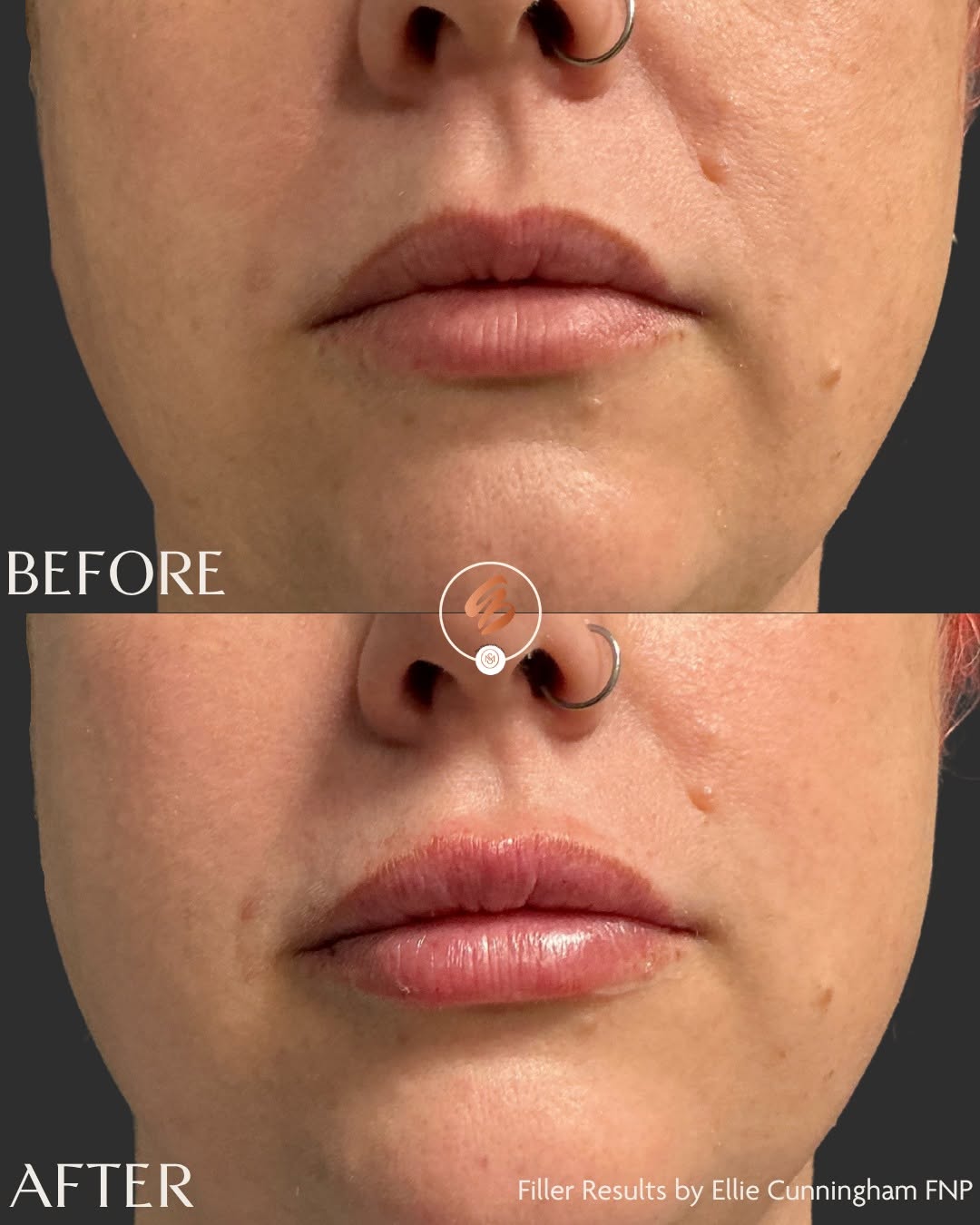 Instagram post by Dr. Amy Brenner: Before and after 1ML of Juvederm Vollure in lips, by Ellie Cunningham, FNP 😍 📲 Call 513-323-7251 or visit the link in bio to schedule a fi…