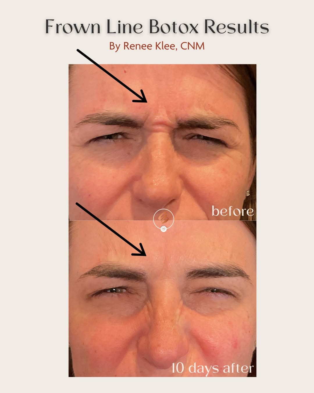 Instagram post by Dr. Amy Brenner: Before and after Botox in frown lines by Renee Klee, CNM 💉✨ Botox and other neurotoxins typically take 10-14 days to yield results. It's FD…