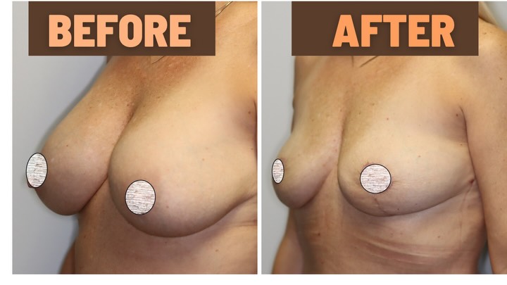 Instagram post by Dr. Amy DeRosa, DO: Explant with areola adjustments performed by Dr. DeRosa. After pictures were taken 6 weeks post op. #explant #breastimplantremoval #breastli…