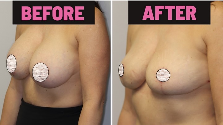 Instagram post by Dr. Amy DeRosa, DO: Before/After explant. After pictures were taken 6 weeks post op. #beforeandafter #plasticsurgery #explant