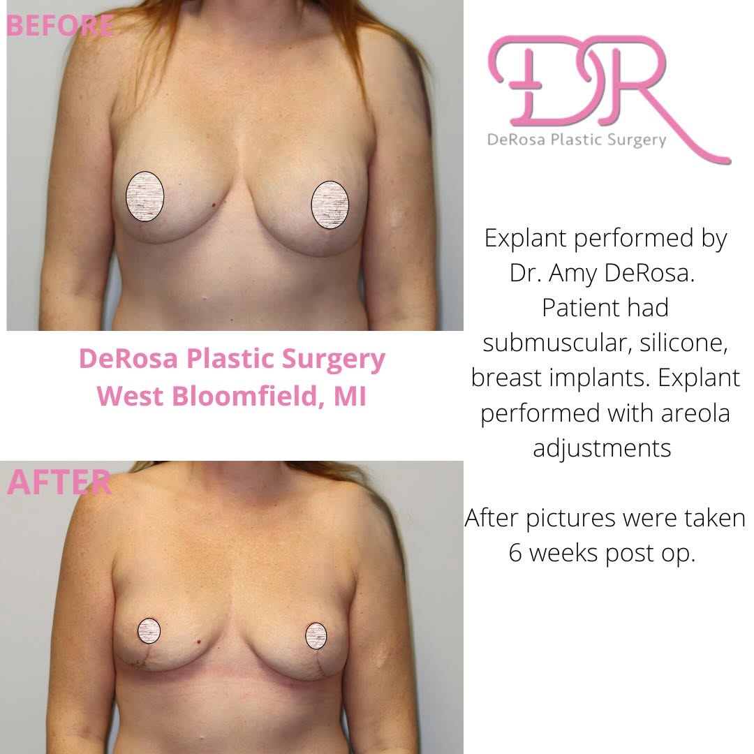 Instagram post by Dr. Amy DeRosa, DO: Explant performed by Dr. Amy DeRosa ✨ Submuscular silicone implants removed with areolar adjustments. These after photos were taken just 6 w…